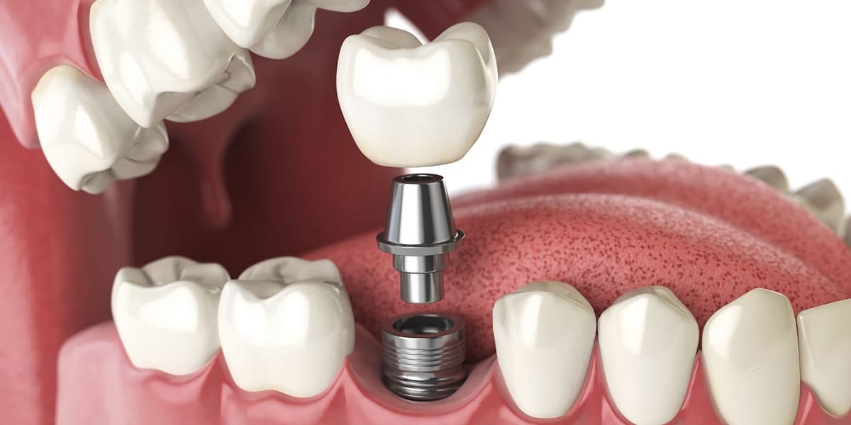 dental-implants-1200px-1a.jpg