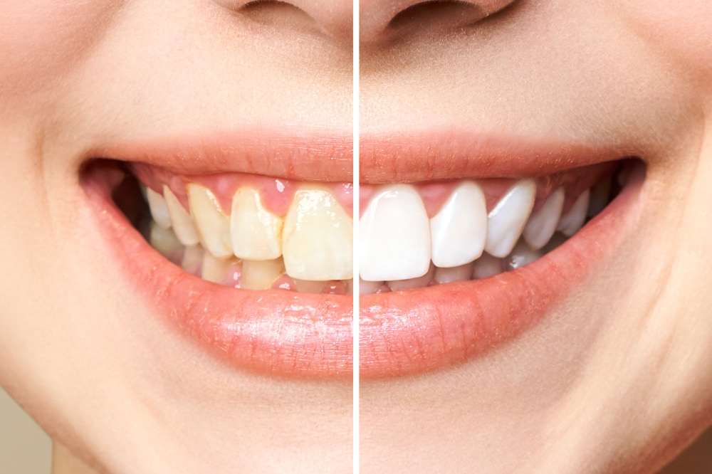 teeth-whitening-in-antalya-1.jpg