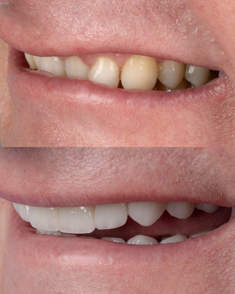 zirconia-crown-1