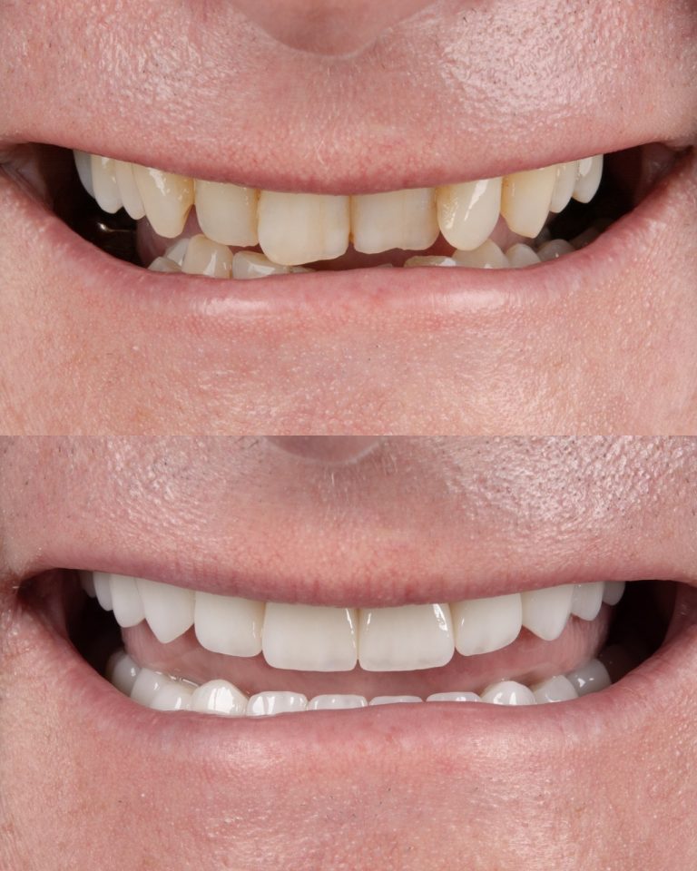 zirconia-crown-2